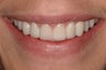 Smile Makeover