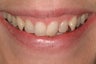Smile Makeover