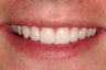 Prepless Veneers