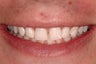 Prepless Veneers