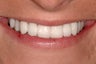 Bridges and Veneers