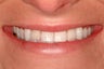 Bridges and Veneers