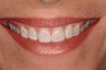 Porcelain Veneers and Whitening
