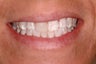 Porcelain Veneers and Whitening