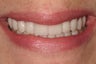 Porcelain Veneers