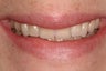 Porcelain Veneers