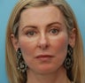 Under Eye Dermafiller, Cheek Dermafiller, Restylane