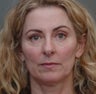Under Eye Dermafiller, Cheek Dermafiller, Restylane