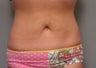 Body Jet and Slim Lipo