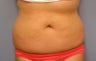 Body Jet and Slim Lipo