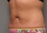 Body Jet and Slim Lipo