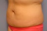 Body Jet and Slim Lipo