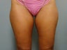 Body Jet and Slim Lipo