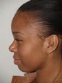 Rhinoplasty