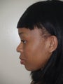 Rhinoplasty
