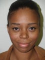 Rhinoplasty
