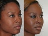 African American Rhinoplasty
