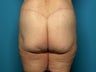 Buttock and Outer Thigh Lift