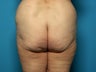 Buttock and Outer Thigh Lift