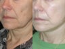 SLUPlift Mini Neck & Jowl Lift