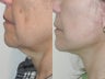 SLUPlift Mini Neck & Jowl Lift