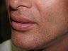 Lip Augmentation
