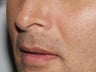 Lip Augmentation
