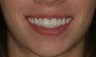 Aesthetic Implants