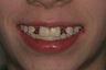 Aesthetic Implants