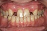 Whitening and Implants
