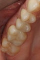 Porcelain Fillings (Inlays and Onlays)
