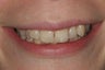 Invisalign