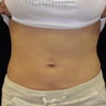 Thermage Abdomen