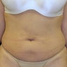 Thermage Abdomen