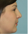 Closed Rhinoplasty
