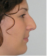 Closed Rhinoplasty