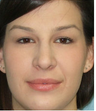 Closed Rhinoplasty