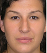 Closed Rhinoplasty