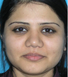 Augmentation Rhinoplasty