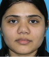Augmentation Rhinoplasty