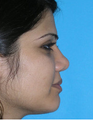 Augmentation Rhinoplasty