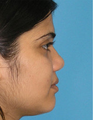 Augmentation Rhinoplasty