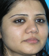 Augmentation Rhinoplasty