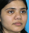 Augmentation Rhinoplasty