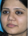 Augmentation Rhinoplasty