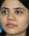 Augmentation Rhinoplasty