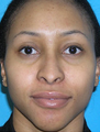 Foundation Septorhinoplasty