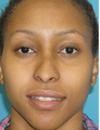 Foundation Septorhinoplasty