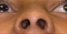 Foundation Septorhinoplasty