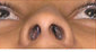 Foundation Septorhinoplasty